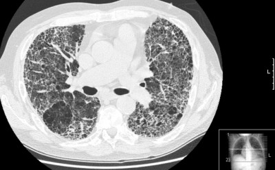 Fibrosi polmonare idiopatica