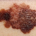 Capelli rossi e melanoma: chiarita meglio la relazione