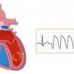Lo stress causa patologie cardiache differenti tra uomini e donne