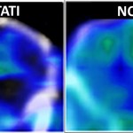 Brevettate nanoparticelle che eliminano le placche amiloidi dell’Alzheimer