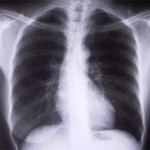 Diagnosticare le infezioni polmonari dall’ “odore” del respiro