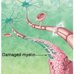 Staminali dalle cellule della pelle: nuova speranza contro la sclerosi multipla